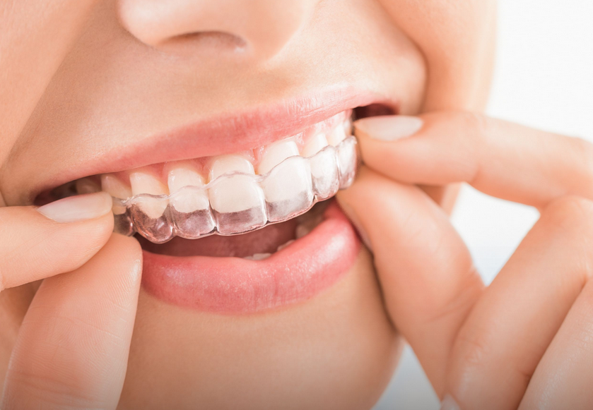 Custom Mouth Guards in Sherman Oaks: Protect Your Smile Day and Night