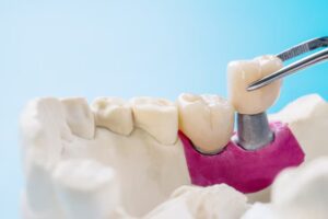 dental implants in Sherman Oaks