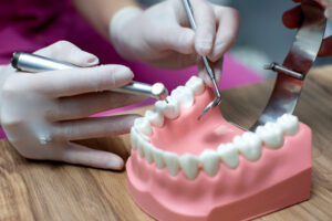 dental onlay