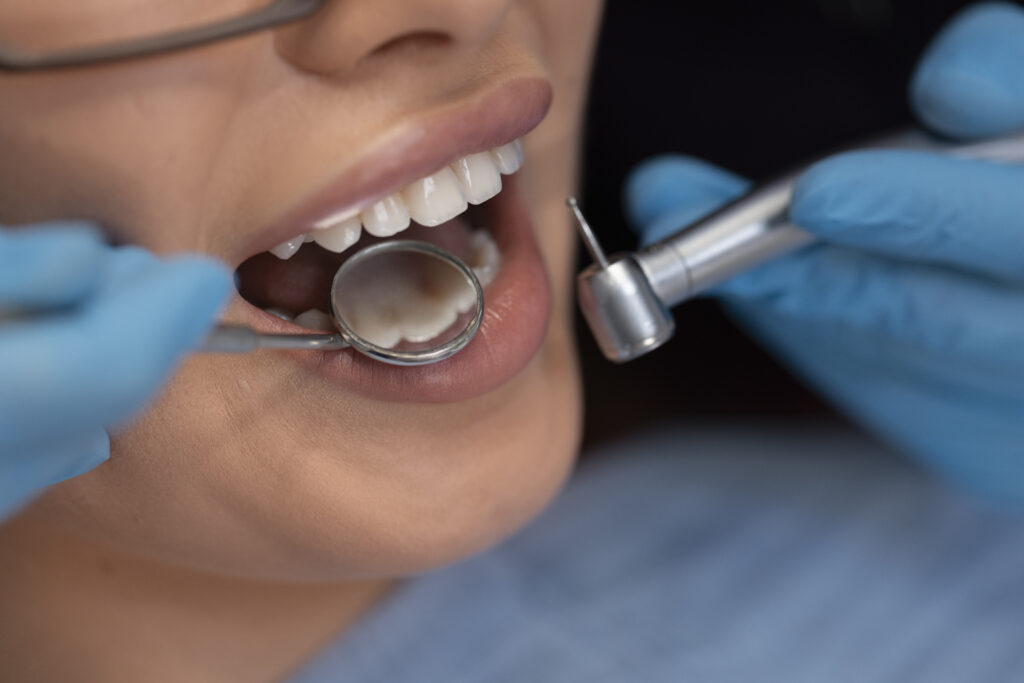 dental crowns
