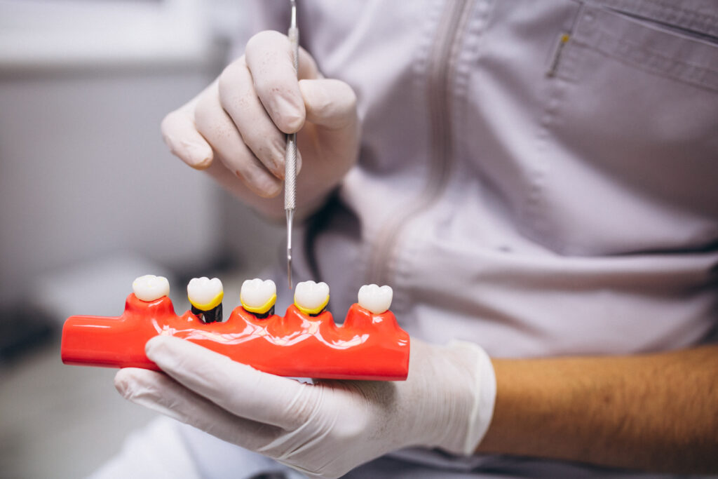 dental crowns