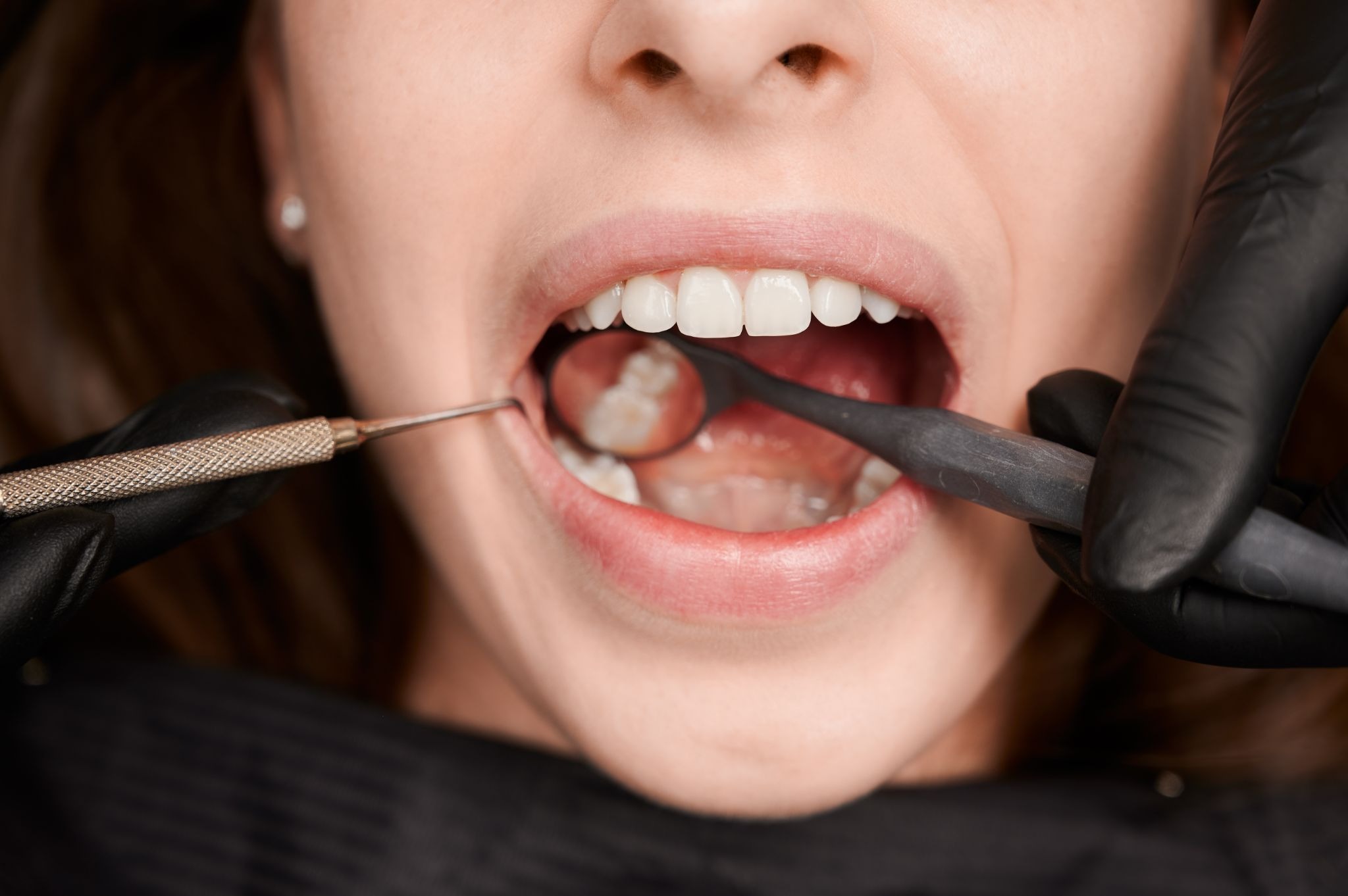 dental fillings in Sherman Oaks