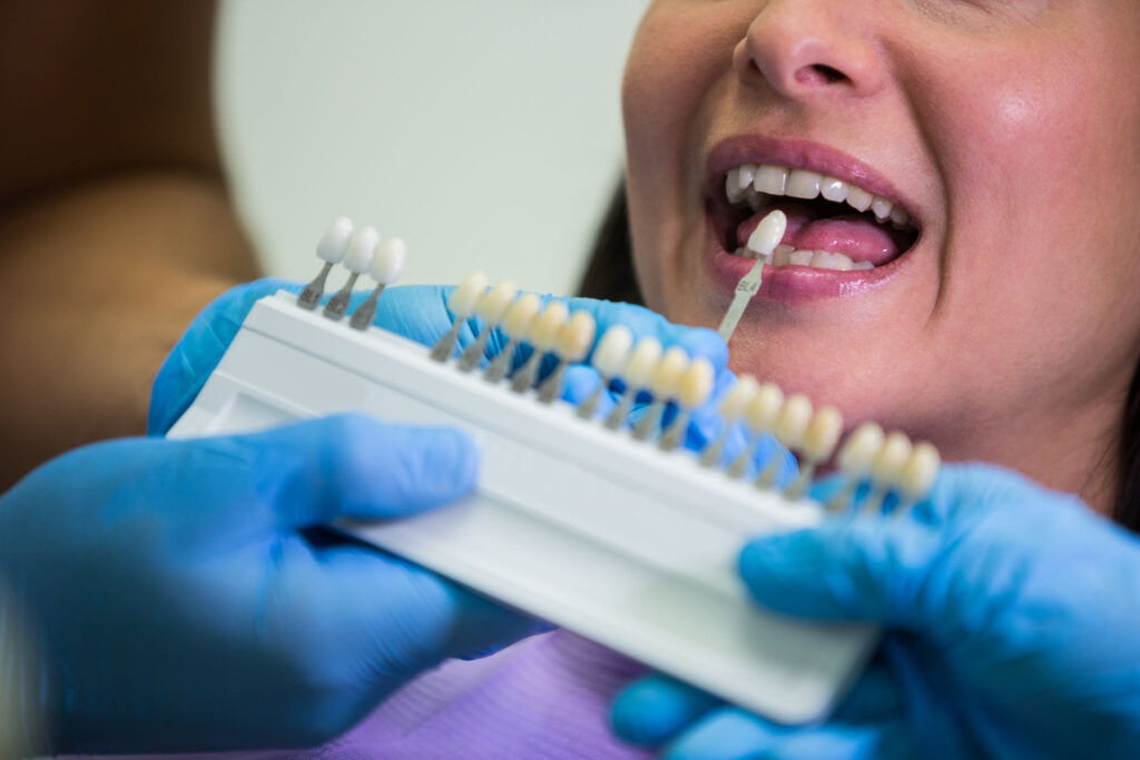 dental veneers in Sherman Oaks